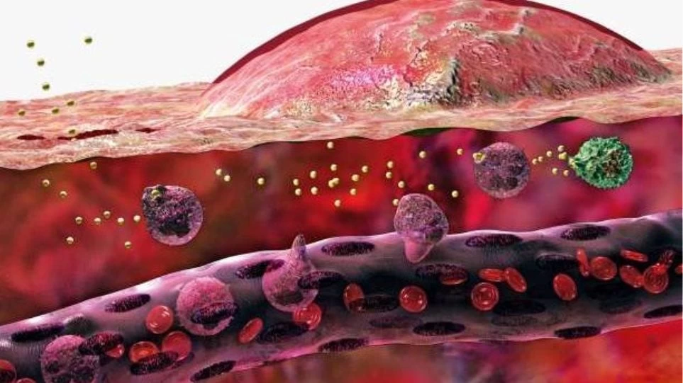 Έρευνα: Η χρόνια φλεγμονή στη μέση ηλικία μπορεί να οδηγήσει σε προβλήματα μνήμης και νόησης